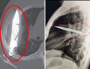Göğüs ağrısıyla hastaneye gitti, göğsünde 8 yıldır bıçakla yaşadığı ortaya çıktı!