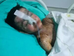 Salatalık yutunca öksürmeye başlayan çocuğun vücudunda kateter unutulduğu ortaya çıktı