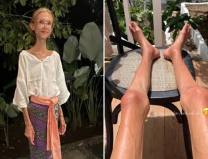 Meyve diyetiyle 20 kiloya kadar düşen sosyal medya fenomeni hayatını kaybetti