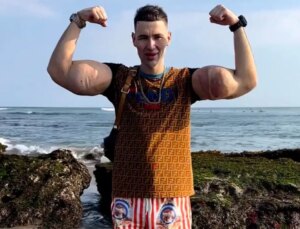 Rus Temel Reis’in kolları tehlikede: Tehlikeli enjeksiyonlar ağır enfeksiyona yol açtı