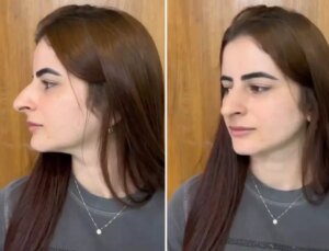 Hevesle burun estetiği oldu ama sonu skandal