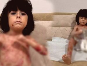 Kelebek Hastalığıyla Mücadele Eden Çocuk İçin Aile Çaresiz Kaldı