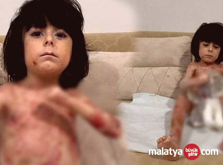 Kelebek Hastalığıyla Mücadele Eden Çocuk İçin Aile Çaresiz Kaldı