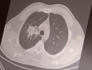 Elektronik Sigara: 20 Yıllık Süre Doldu, Kanser Riski Ortada