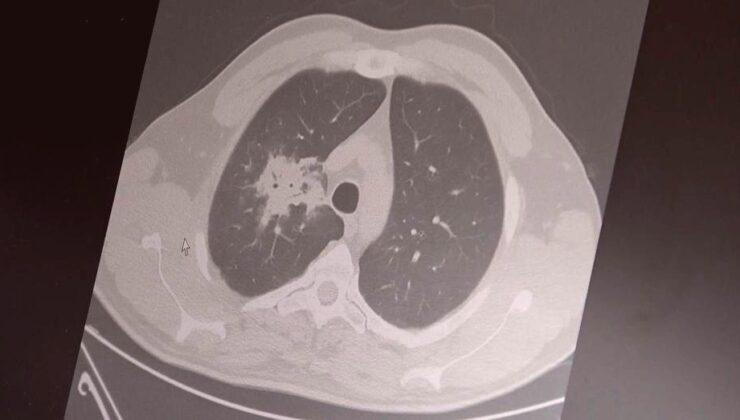 Elektronik Sigara: 20 Yıllık Süre Doldu, Kanser Riski Ortada