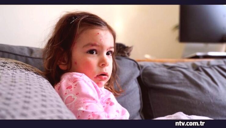 İstanbul’da Kızamık Vaka Artışı: Unutulan Hastalık Geri mi Dönüyor?